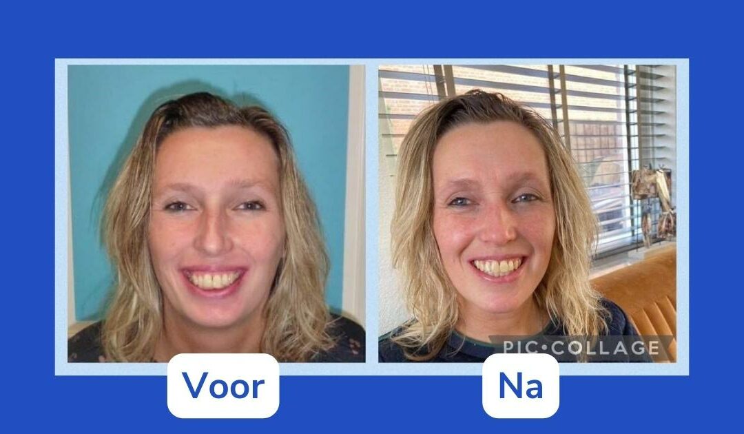 Chantal over haar kaakoperatie vanwege een overbeet