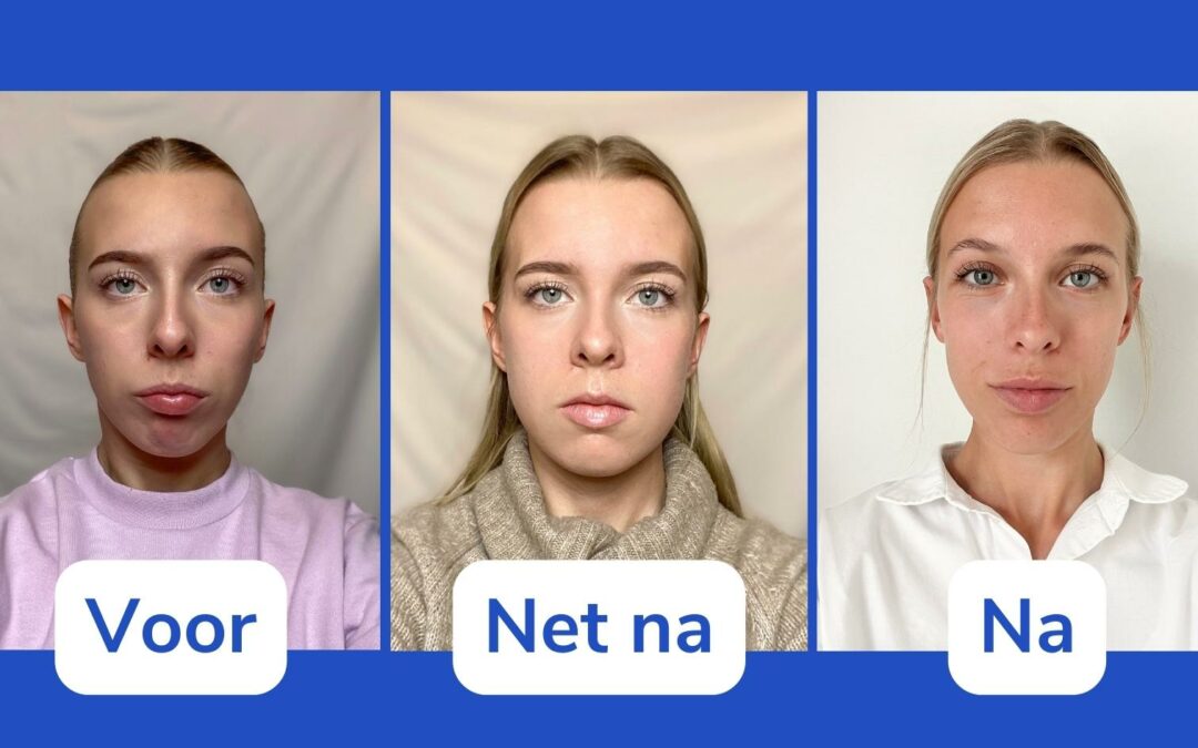 Sanne vertelt over haar ervaring met een kaakoperatie en de herstelperiode