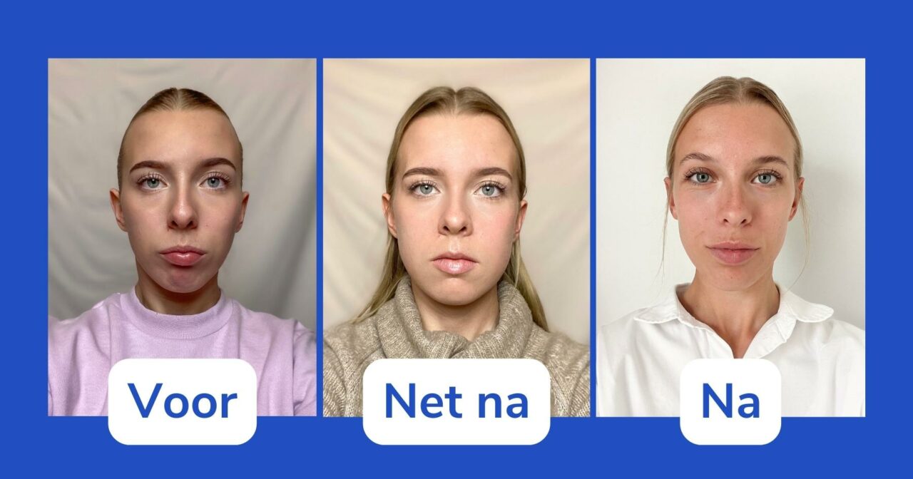 Sanne vertelt over haar ervaring met een kaakoperatie