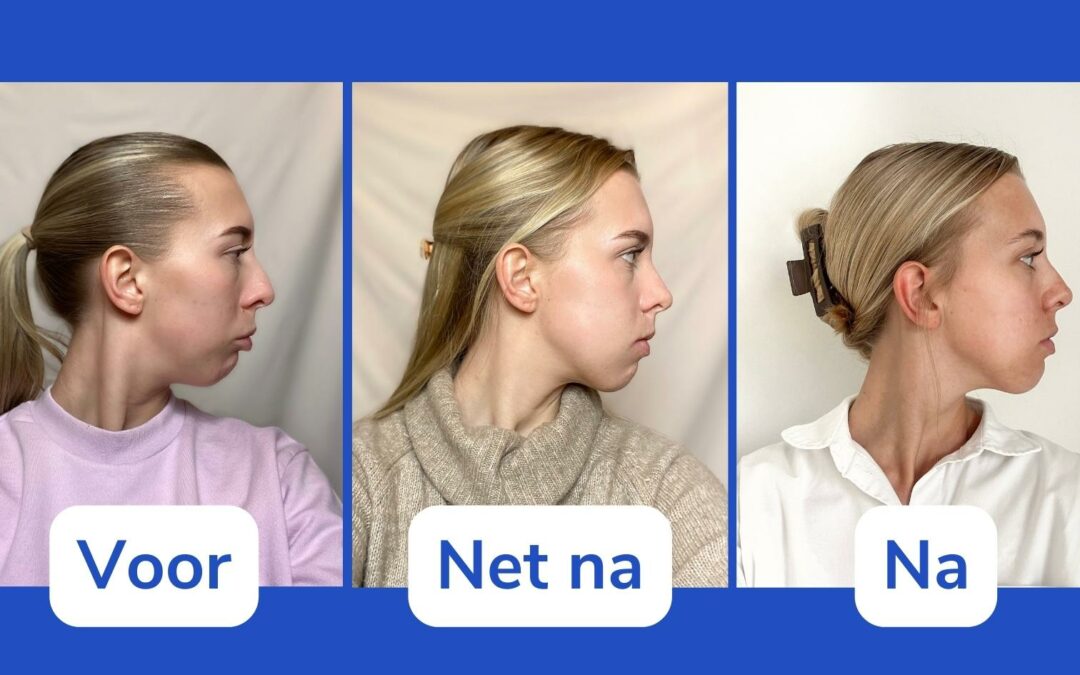 Foto’s van voor en na een kaakoperatie