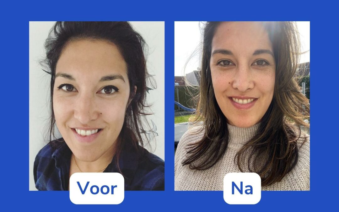 Gail over haar ervaring met een dubbele kaakoperatie en kincorrectie